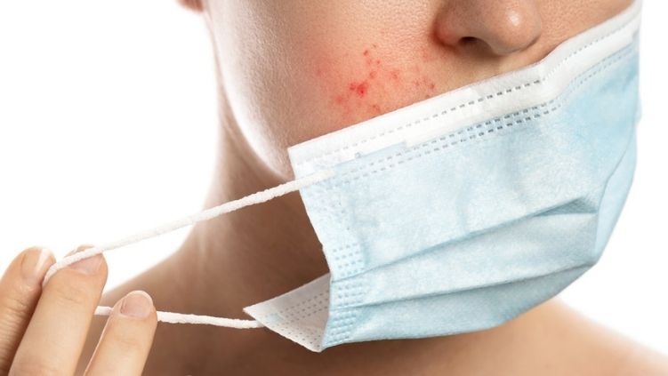 Maskné, el nuevo dolor de cabeza de las adolescentes