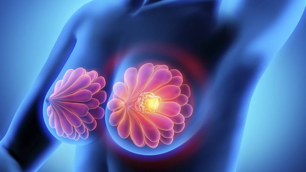 Conoce los factores de riesgo más frecuentes del Cáncer de mama